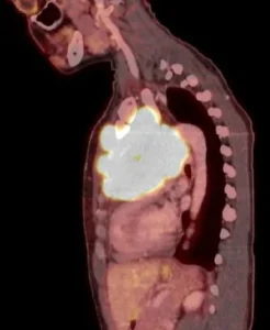 medizinische Bildgebung vom Tumor